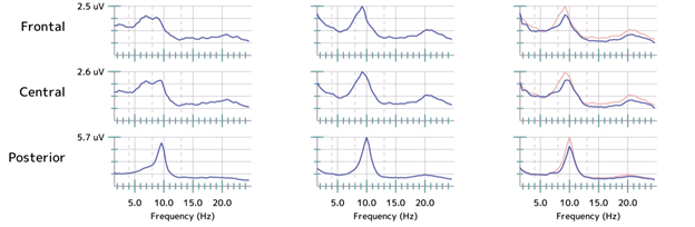 Bipolar 1 Disorder PTSD full