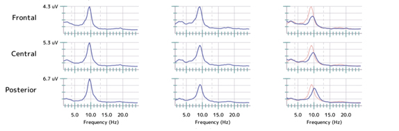 Chronic Depression with suicidal