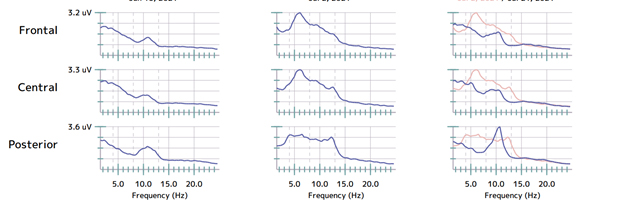 Depression PTSD ADHD