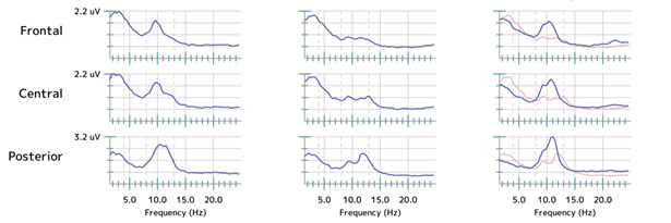 PTSD Depression with suicidal ideation Fibromyalgia